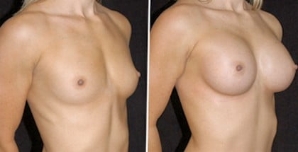 Увеличение нулевого размера груди до и после операции фото