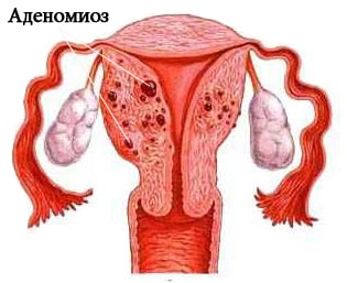 Аденомиоз матки фото
