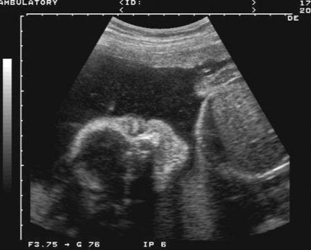 ВПГ при беременности фото