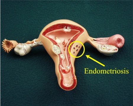 Эндометриоз — фото