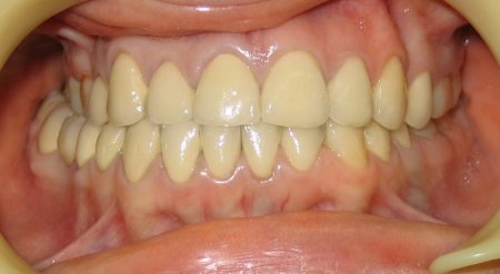 Металлокерамика зубы — цена фото