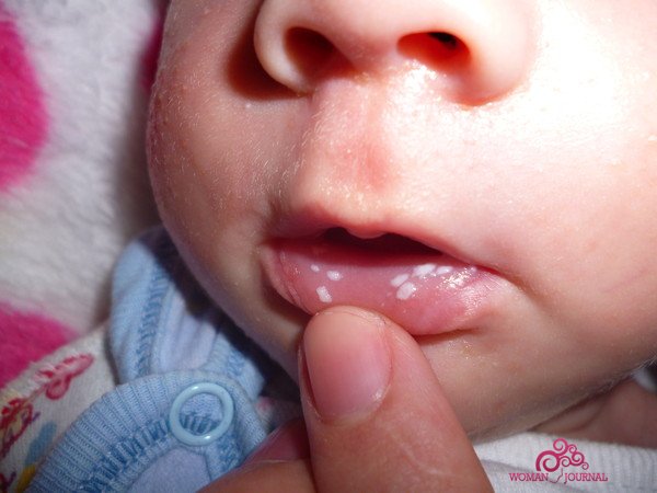 Молочница во рту у ребенка: причины, лечение и профилактика