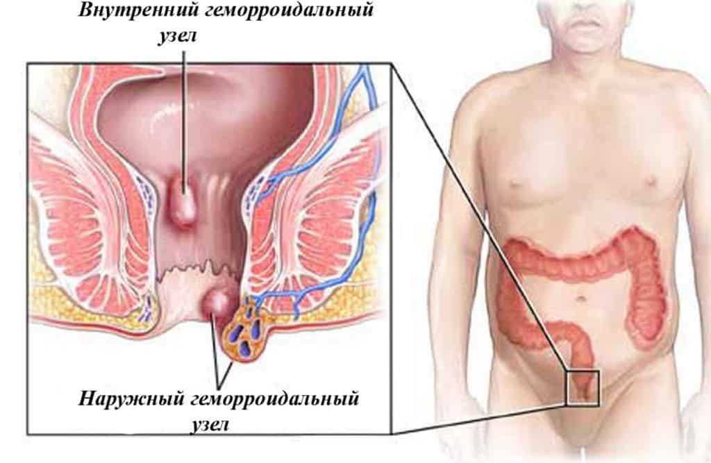лечение геморроя при грудном вскармливании